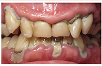 Advanced periodontitis