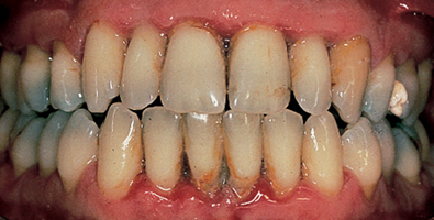 teeth with periodontis on the gum line and bone
