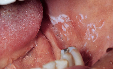 leukoplakia inside the mouth