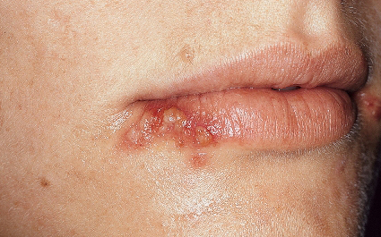 cold sores and blisters on the lip