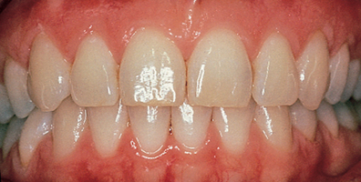Healthy Gums. Teeth are held firmly in place by the gums, bone and periodontal ligament
