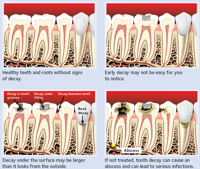 Diagram of the process of tooth decay