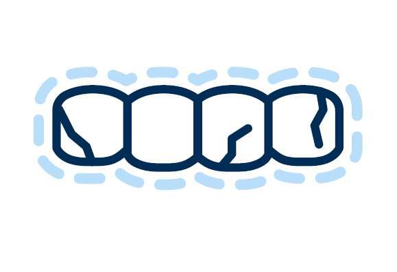Representation of Veneers | Aspen Dental