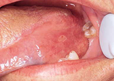 erythroplakia, red patches in the mouth and gum