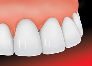 a ceramic veneer after being placed on a chipped tooth